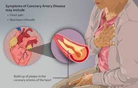 Coronary Disorder